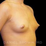 Breast Augmentation Before & After Patient #8888