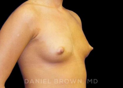 Breast Augmentation Before & After Patient #8888