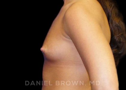 Breast Augmentation Before & After Patient #8888