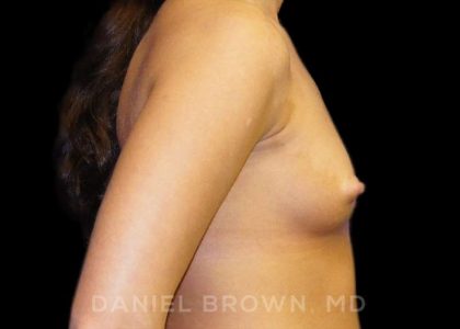 Breast Augmentation Before & After Patient #8888