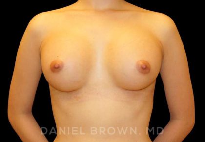Breast Augmentation Before & After Patient #8899