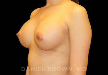 Breast Augmentation Before & After Patient #8899