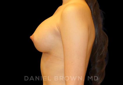 Breast Augmentation Before & After Patient #8899