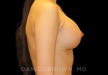 Breast Augmentation Before & After Patient #8899