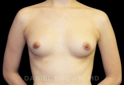 Breast Augmentation Before & After Patient #8899