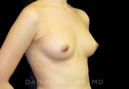 Breast Augmentation Before & After Patient #8899