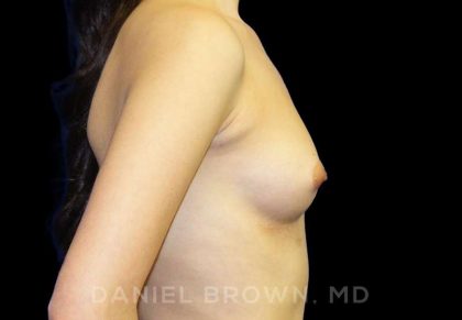 Breast Augmentation Before & After Patient #8899