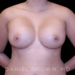 Breast Augmentation Before & After Patient #8910