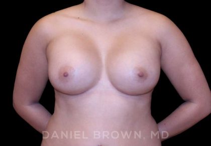 Breast Augmentation Before & After Patient #8910