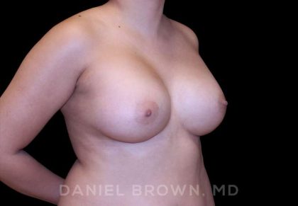 Breast Augmentation Before & After Patient #8910