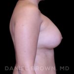 Breast Augmentation Before & After Patient #8910