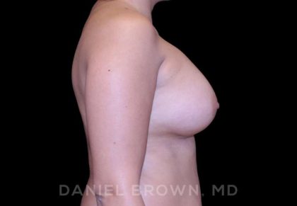 Breast Augmentation Before & After Patient #8910