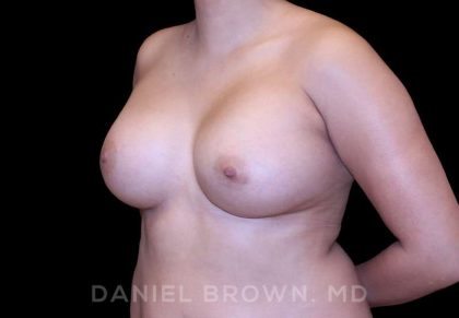 Breast Augmentation Before & After Patient #8910