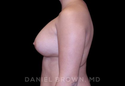 Breast Augmentation Before & After Patient #8910