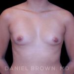 Breast Augmentation Before & After Patient #8910
