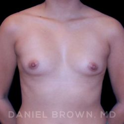 Breast Augmentation Before & After Patient #8910