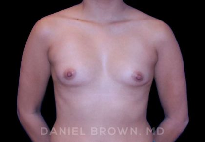Breast Augmentation Before & After Patient #8910