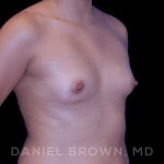 Breast Augmentation Before & After Patient #8910