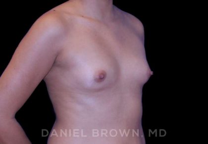 Breast Augmentation Before & After Patient #8910