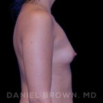 Breast Augmentation Before & After Patient #8910