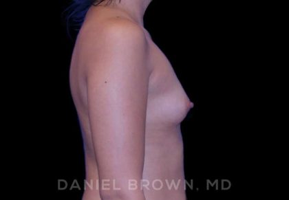 Breast Augmentation Before & After Patient #8910