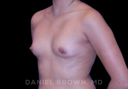 Breast Augmentation Before & After Patient #8910