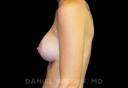 Breast Augmentation Before & After Patient #8921