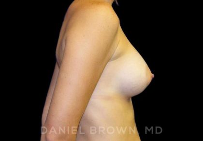 Breast Augmentation Before & After Patient #8921