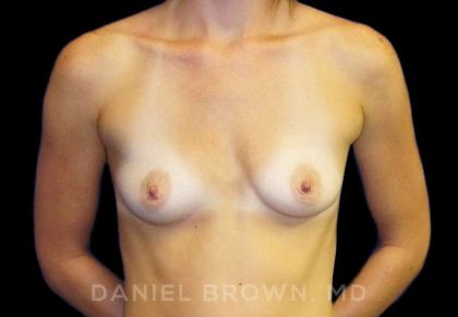 Breast Augmentation Before & After Patient #8921