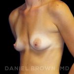 Breast Augmentation Before & After Patient #8921