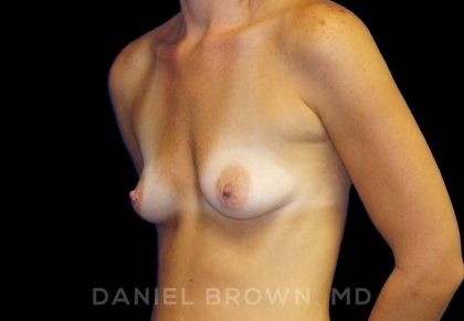 Breast Augmentation Before & After Patient #8921