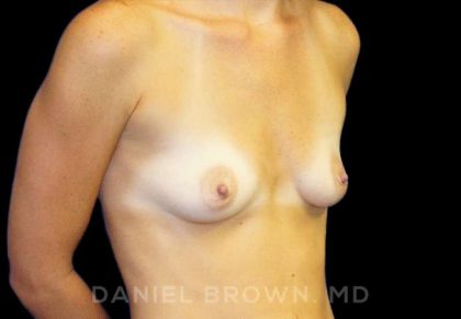Breast Augmentation Before & After Patient #8921