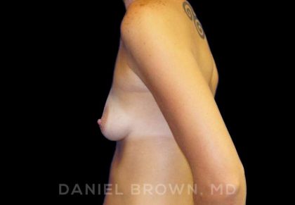 Breast Augmentation Before & After Patient #8921