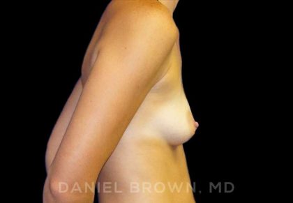 Breast Augmentation Before & After Patient #8921