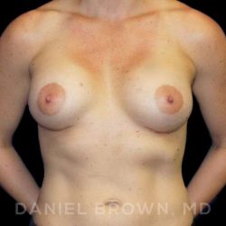 Breast Augmentation Before & After Patient #8932