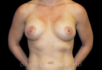 Breast Augmentation Before & After Patient #8932