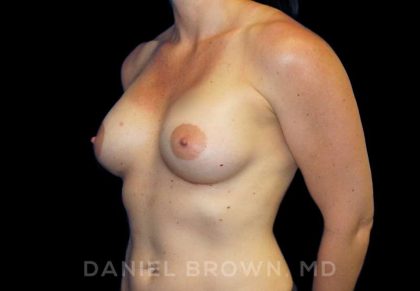 Breast Augmentation Before & After Patient #8932