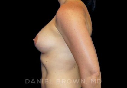 Breast Augmentation Before & After Patient #8932