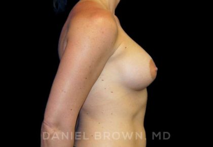 Breast Augmentation Before & After Patient #8932