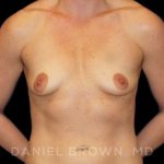 Breast Augmentation Before & After Patient #8932