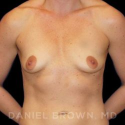 Breast Augmentation Before & After Patient #8932