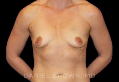 Breast Augmentation Before & After Patient #8932