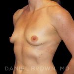 Breast Augmentation Before & After Patient #8932
