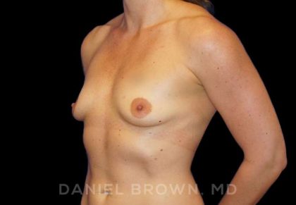 Breast Augmentation Before & After Patient #8932