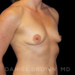 Breast Augmentation Before & After Patient #8932