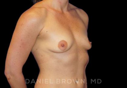 Breast Augmentation Before & After Patient #8932