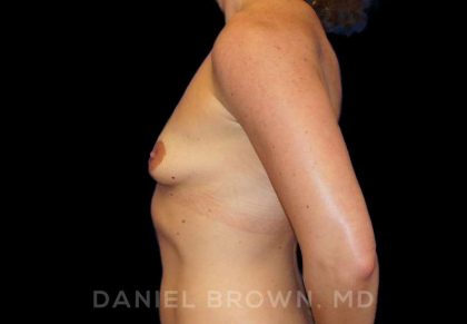 Breast Augmentation Before & After Patient #8932