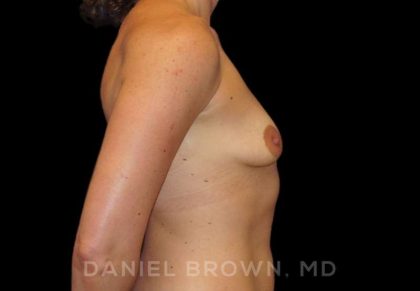 Breast Augmentation Before & After Patient #8932