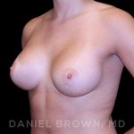 Breast Augmentation Before & After Patient #8943