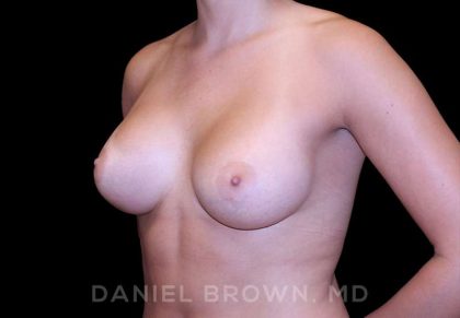 Breast Augmentation Before & After Patient #8943